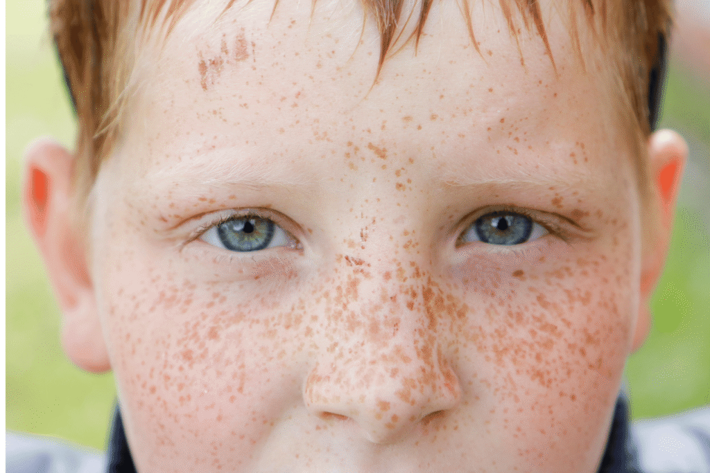 freckles