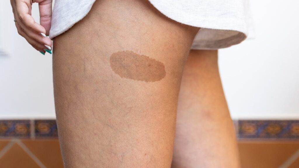 A Birthmark