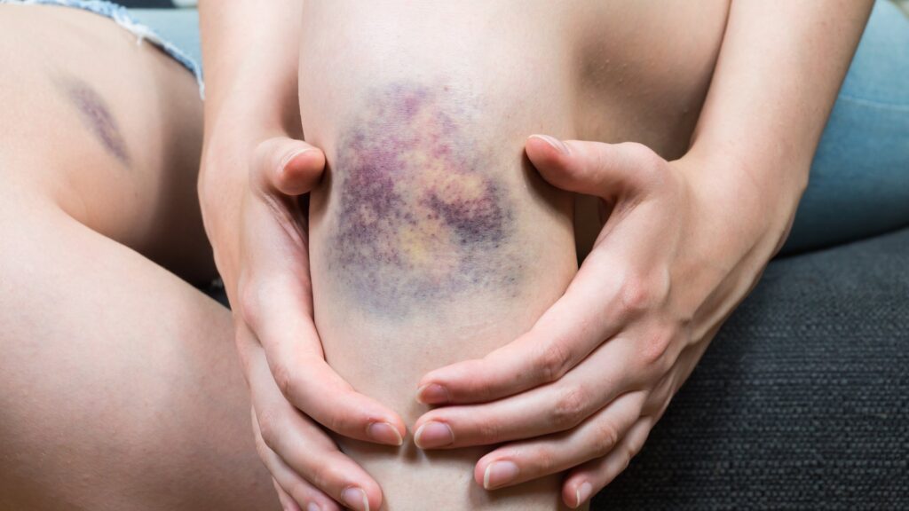 bruise