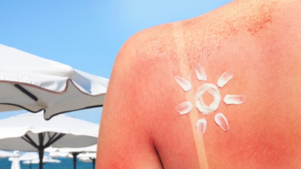 A Sunburn
