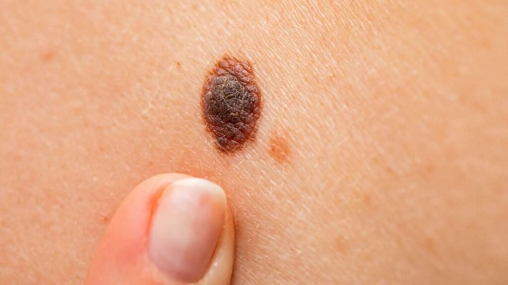 A mole