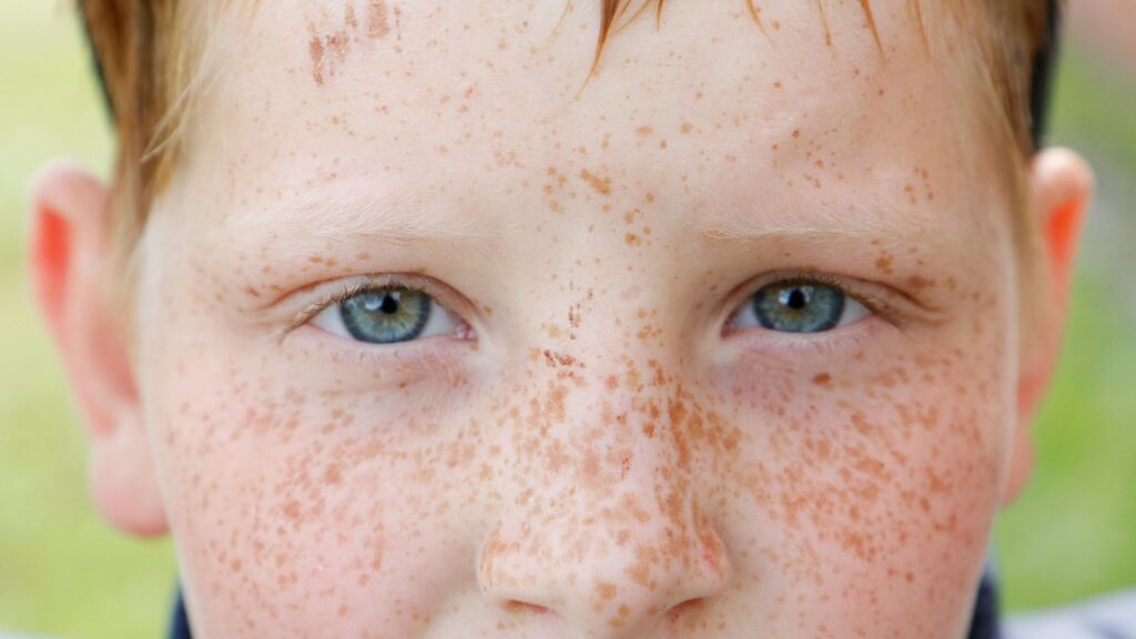 freckles
