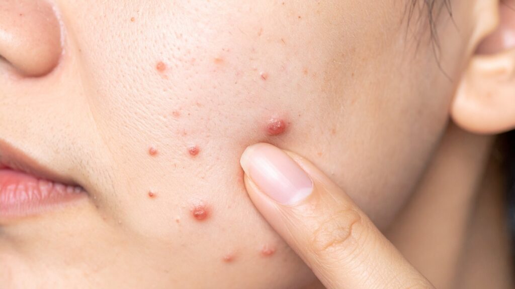 Pimples
