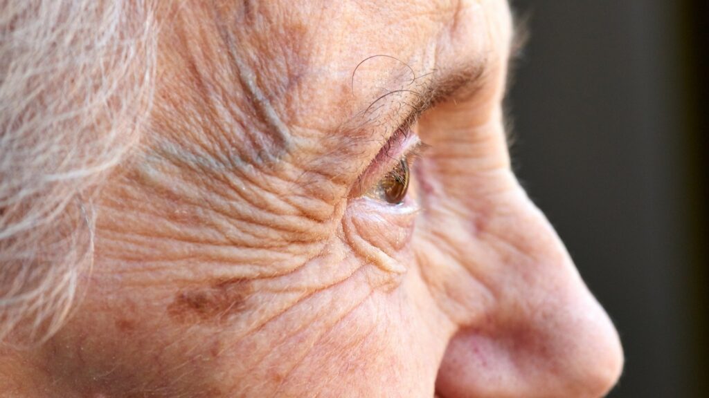 Wrinkles